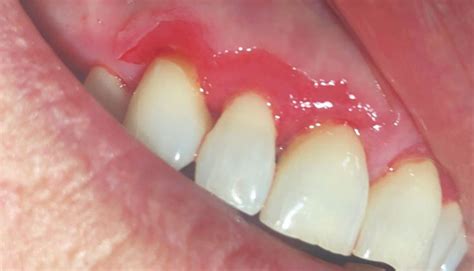 Managing Desquamative Gingivitis - Dimensions of Dental Hygiene