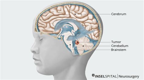 Medulloblastoma | Neurosurgery Inselspital Bern