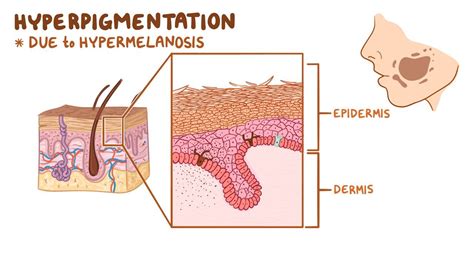 Benign hyperpigmented skin lesions: Clinical: Video | Osmosis