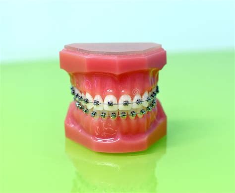 Model of Dental Appliance Showing Braces Stock Photo - Image of braces, orthodontic: 117490014