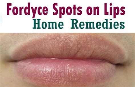 14 Home Remedies For Fordyce Spots On Lips Treatment