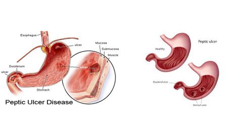 Acid Peptic Disease Treatment in Aligarh, Acid Peptic Disease Diagnosis UP