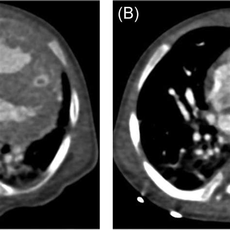 CTA of the left atrium and pulmonary veins show severe diameter... | Download Scientific Diagram