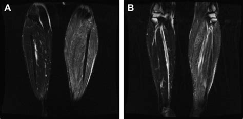 Muscle Biopsy Evaluation in Neuromuscular Disorders | Musculoskeletal Key