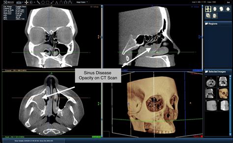 In-Office-CT-Scan-sinuses - Otolaryngology Specialists of North Texas