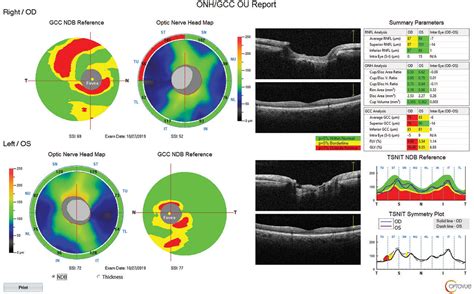 How Do OCT Devices for Glaucoma Compare?