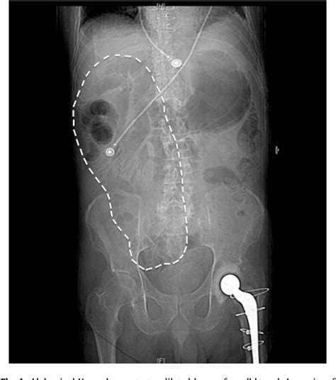 Figure 1 from An unusual presentation of congenital intestinal ...