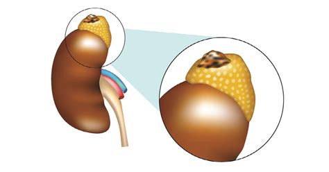 Pheochromocytoma: Symptoms, Causes, Risk Factors , Diagnosis, Treatment & Complications