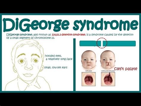 DiGeorge Syndrome || Deletion Syndrome || Immunodeficiency , 54% OFF