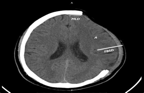 Post-Cranioplasty Complications: Lessons From a Prospective... : Journal of Craniofacial Surgery