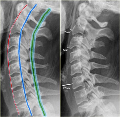 The Radiology Assistant : Cervical injury