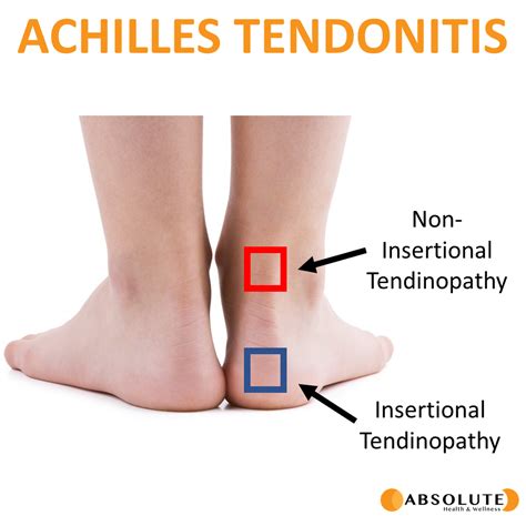 Shockwave for Achilles Tendonitis - Absolute Health & Wellness