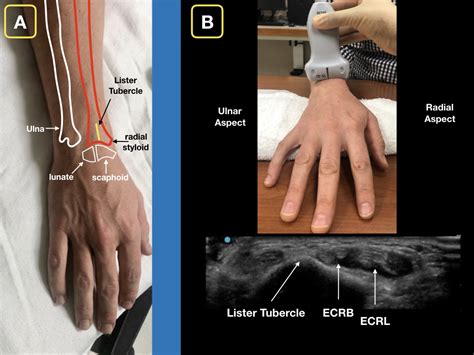 Easy Ultrasound Technique to Evaluate and Aspirate an Atraumatic Painful Wrist - ACEP Now