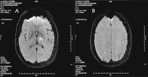 Brain magnetic resonance imaging (MRI) showed patchy and punctate ...