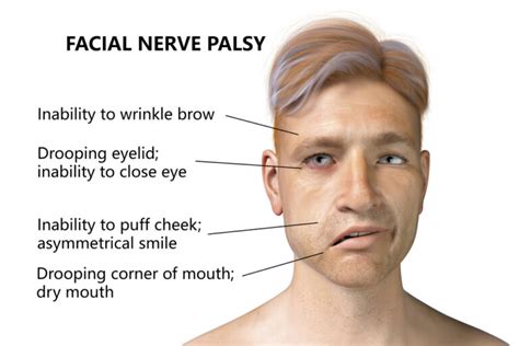 Bell’s Palsy Causes, Symptoms, and Treatments