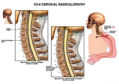 Cervical Radiculopathy - Houston Neurosurgery & Spine