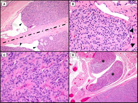 Frontiers | Genetics, Diagnosis, and Management of Hürthle Cell Thyroid ...