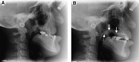 References in External Versus Internal Distraction Osteogenesis for the Management of Severe ...