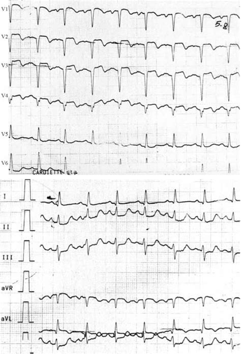 Signs of acute anteroseptal myocardial infarction on admission... | Download Scientific Diagram