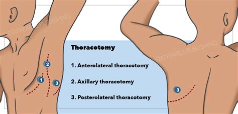 Anatomy, Thoracotomy and the Collateral Intercostal Neurovascular Bundle Article