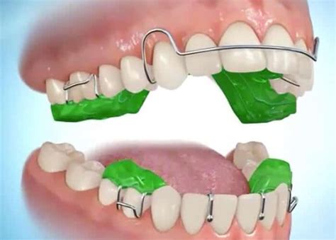 Types of Treatment | Hawke's Bay Orthodontics