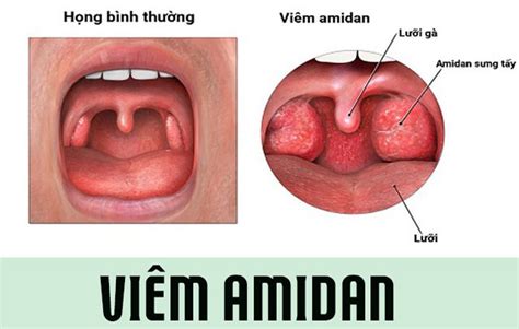 Viêm Amidan Cấp: Dấu Hiệu Và Cách Điều Trị Dứt Điểm