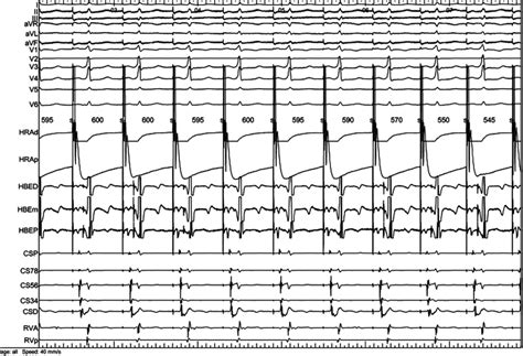 Intracardiac atrial pacing at 600 ms. Note atrial pacing does not ...