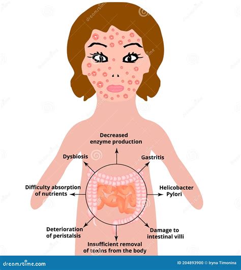 The Anatomical Structure of the Intestine. Bowel Diseases Affect the ...