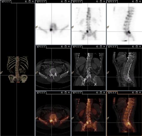 Pain Management & Nuclear Medicine SPECT/CT Imaging | CitiScan ...