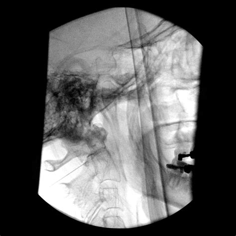 Atlantoaxial (C1-C2) joint injection - Samer Narouze, MD, PhD