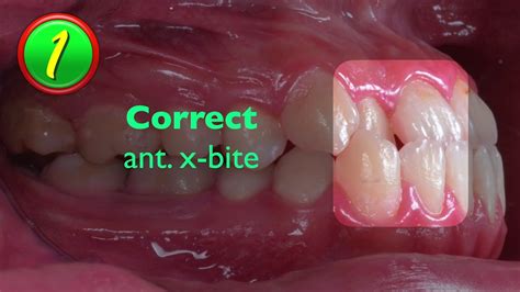 Correcting Anterior Crossbite for Patients with Extraction Space｜【Chris Chang Ortho】CC438 - YouTube