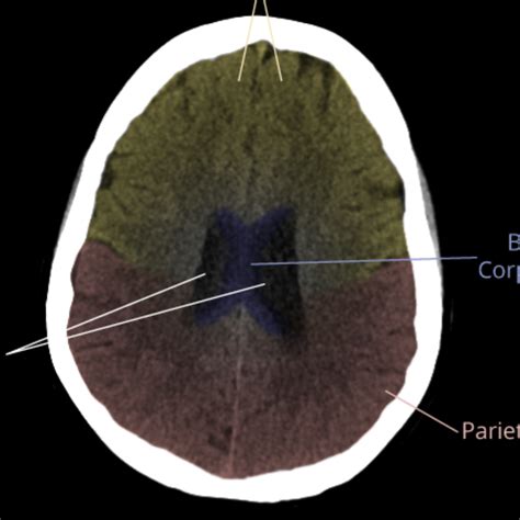 CaseStacks.com - CT Brain Anatomy