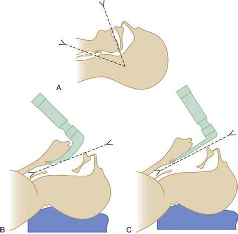 Intubation Equipment | Anesthesia Key