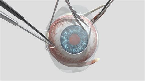 Scleral Buckle - Step 1 - 3D model by Holoxica [93560df] - Sketchfab