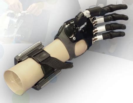 iLimb Digits Quantum Prosthetic Hand | MCOP Prosthetics