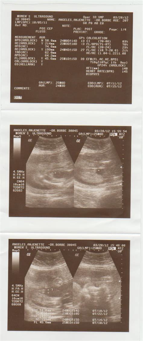 OUR INFERTILITY BATTLE: CAS = Congenital Anomaly Scan (repeat)