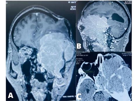 Contrast-enhanced MRI of the brain with brain and paranasal sinus. A, B ...