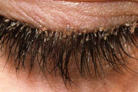 Eyelash(Demodex) Mites-Pictures on Dogs, Human Scalp, Face & How to get ...