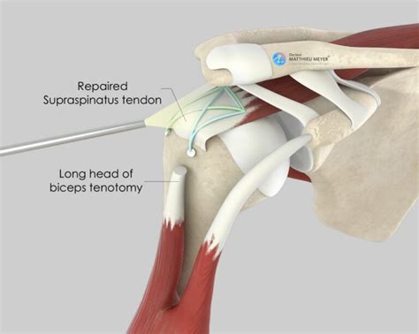 Arthroscopic Rotator Cuff Repair - Doctor Matthieu Meyer