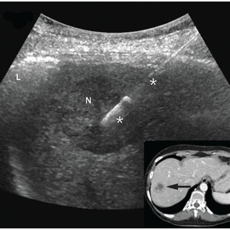 An ultrasonography-guided biopsy of the liver. A suspected metastasis... | Download High-Quality ...