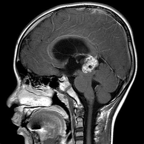 Cyst of the pineal gland: causes, symptoms, treatment - All information ...