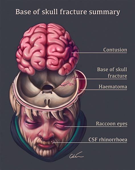 basal skull fracture sign - Deirdre Quinn