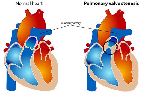 Pulmonary valve stenosis causes, symptoms, diagnosis & treatment