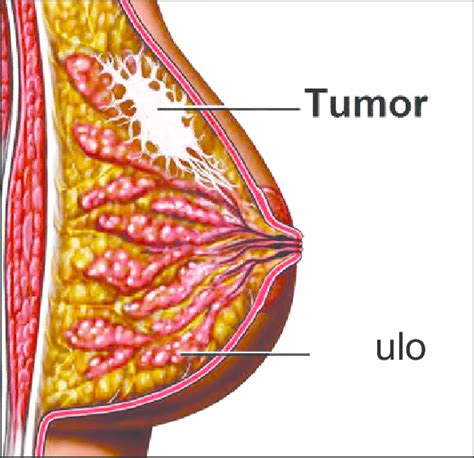 Invasive Lobular Carcinoma