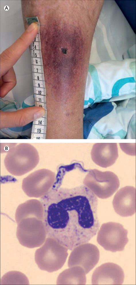 Second stage human African Trypanosomiasis with Trypanosoma brucei rhodesiense treated with ...