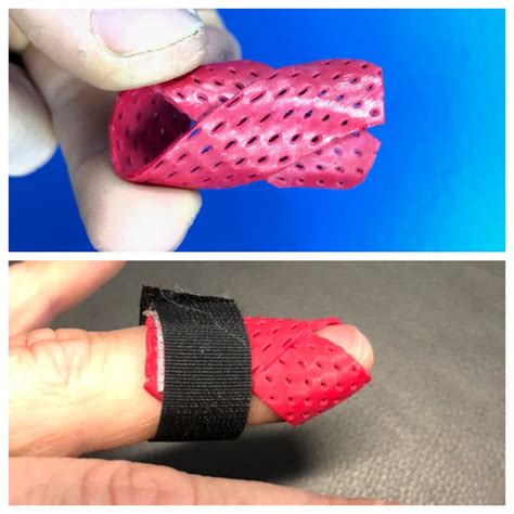 Mallet Injury with Different Mallet Finger Splint Pattern