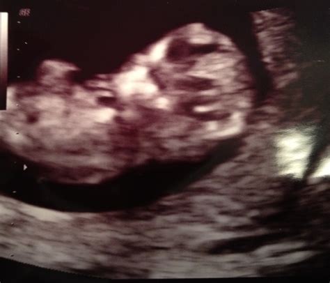 1st Trimester Ultrasounds | MYT is Me!