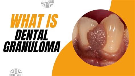 What is Dental Granuloma? Causes, Symptoms, and Treatment - YouTube