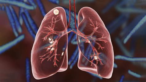 What are Lung Nodules? | Northwestern Medicine