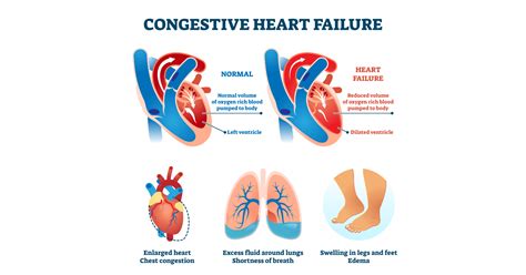 Congestive Heart Failure: Symptoms, Causes, Types & Treatments